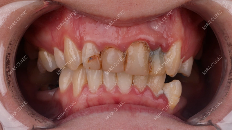 Patients Before Getting Veneers
